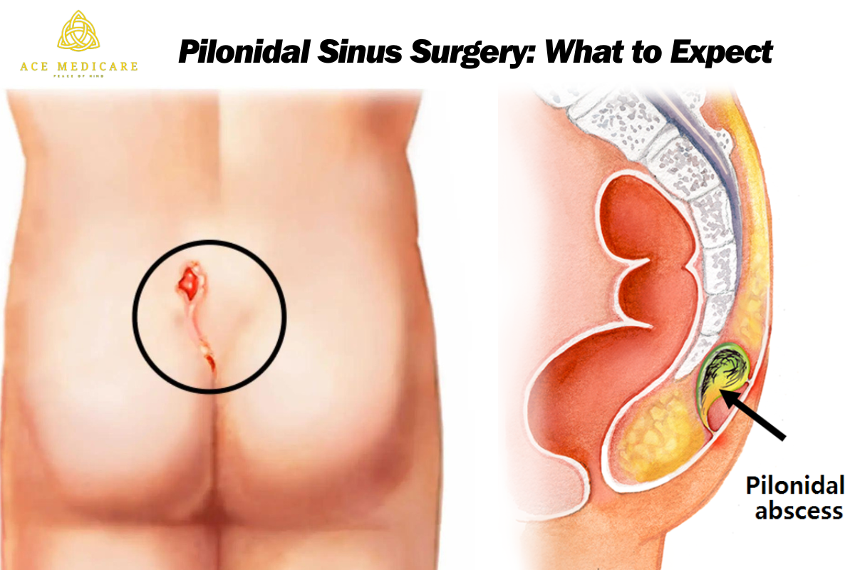 The Complete Guide to Pilonidal Sinus Surgery: What to Expect